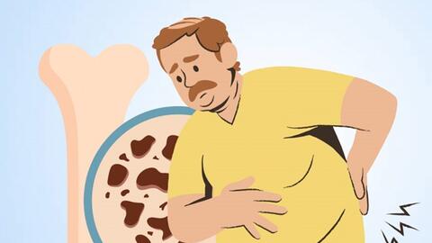 Loãng xương và gãy xương: Vai trò của phát hiện sớm trong phòng ngừa