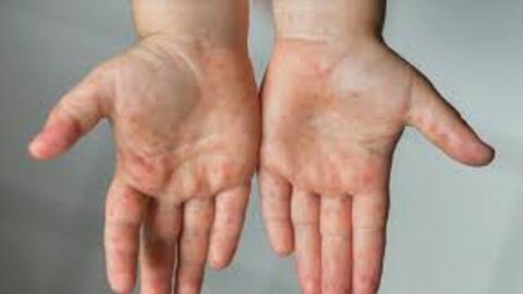 Tay chân miệng gia tăng: Cảnh giác dấu hiệu không điển hình