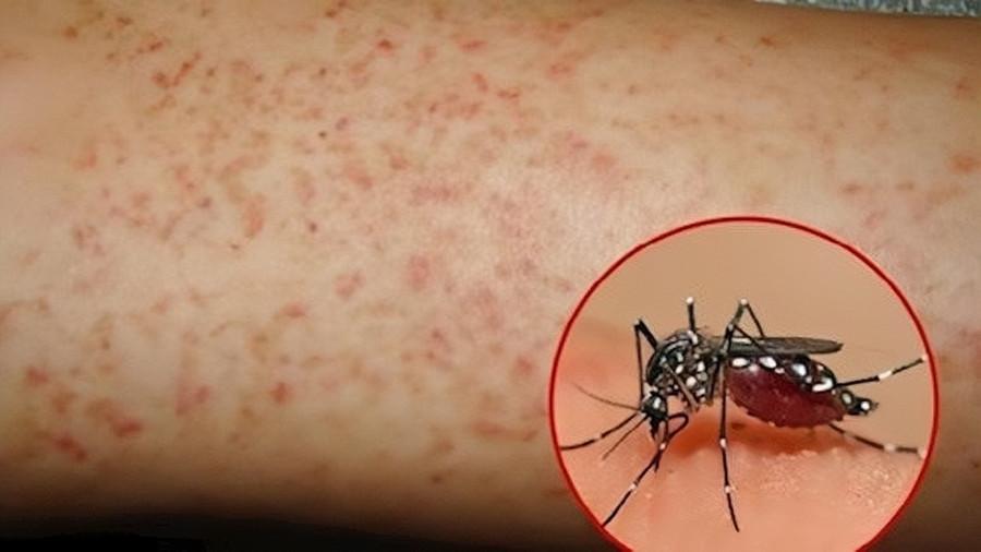 Các địa phương ghi nhận nhiều ca mắc tập trung ở các huyện Nhà Bè, Củ Chi và Cần Giờ