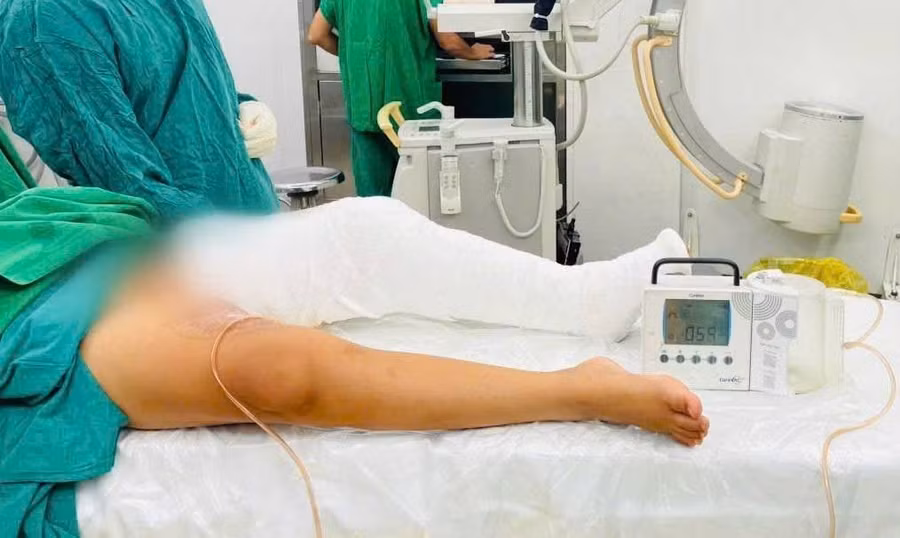 Sau mổ, chân bé được cố định bằng nẹp bột tư thế duỗi thẳng.